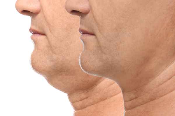 HIFU - Breakthrough in Anti - ageing 2 hifu results West Drayton