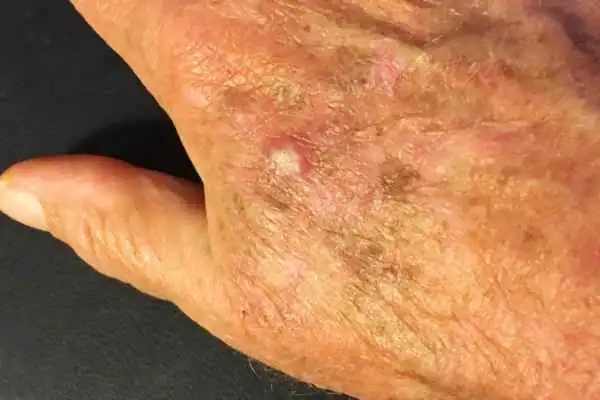 Cryopen For Actinic Keratoses 1 Image of Actinic keratoses West Drayton on a person hand