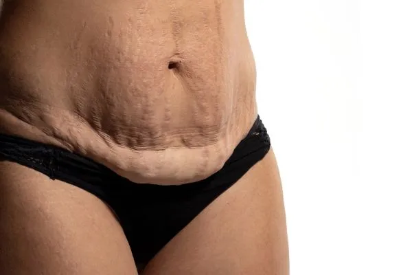 The Science of Skin Tightening 1 The science behind skin tightening West Drayton picture of a woman's sagging skin on the stomach